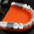 Teeth with a silver teeth prothesis image