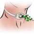 Sputum's deflector for tracheotomy / déflecteur de crachats pour trachéotomie image